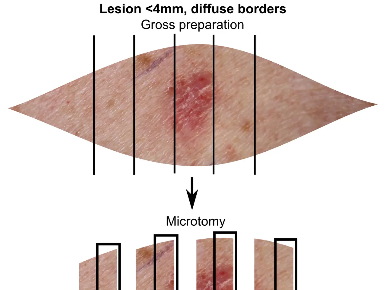 The image shows a diagram of a person's skin with the words "lesion 4mm, diffuse borders, gross...