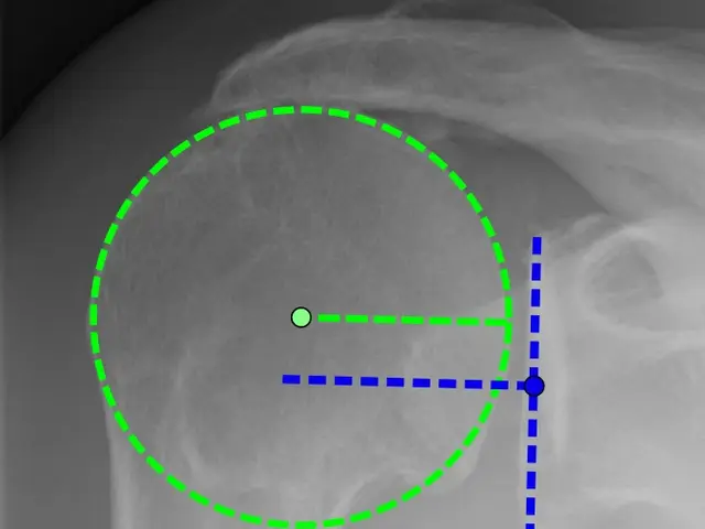 The image shows an x-ray of a man's shoulder with a green circle in the middle, which appears to be...