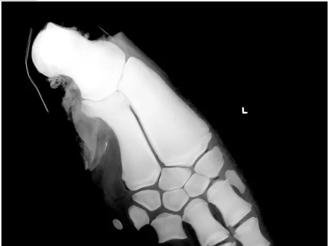 The image shows an x-ray of a man's leg with a fracture in the middle of it, set against a black...
