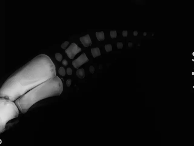 The image shows an x-ray of a human leg with a fracture in the ankle. The background is black and...