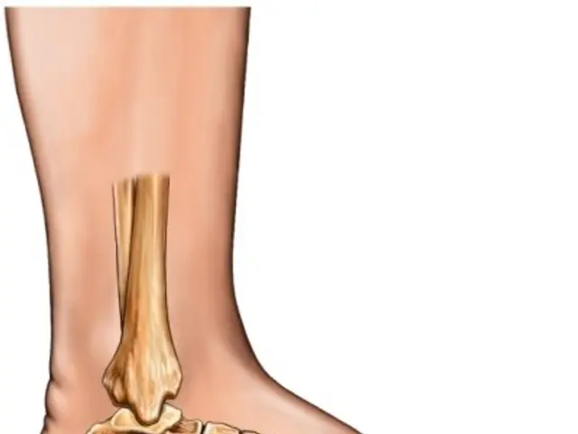 The image shows a diagram of the foot with a fracture in the ankle, providing a visual...