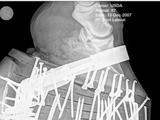 The image shows an x-ray of a man's foot with a fracture in the ankle. The fracture is visible as a...