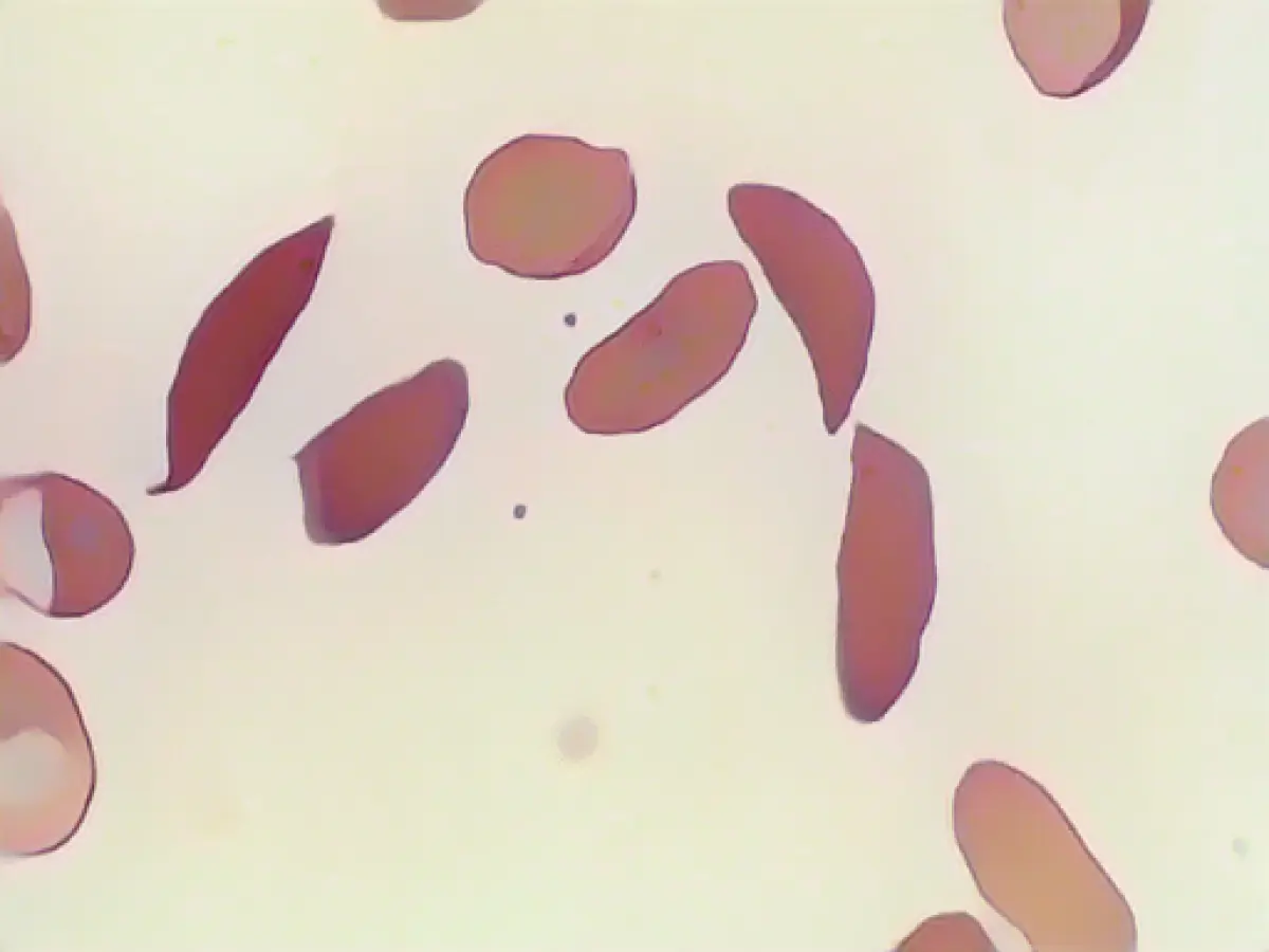 Great Britain approves first therapy with gene scissors