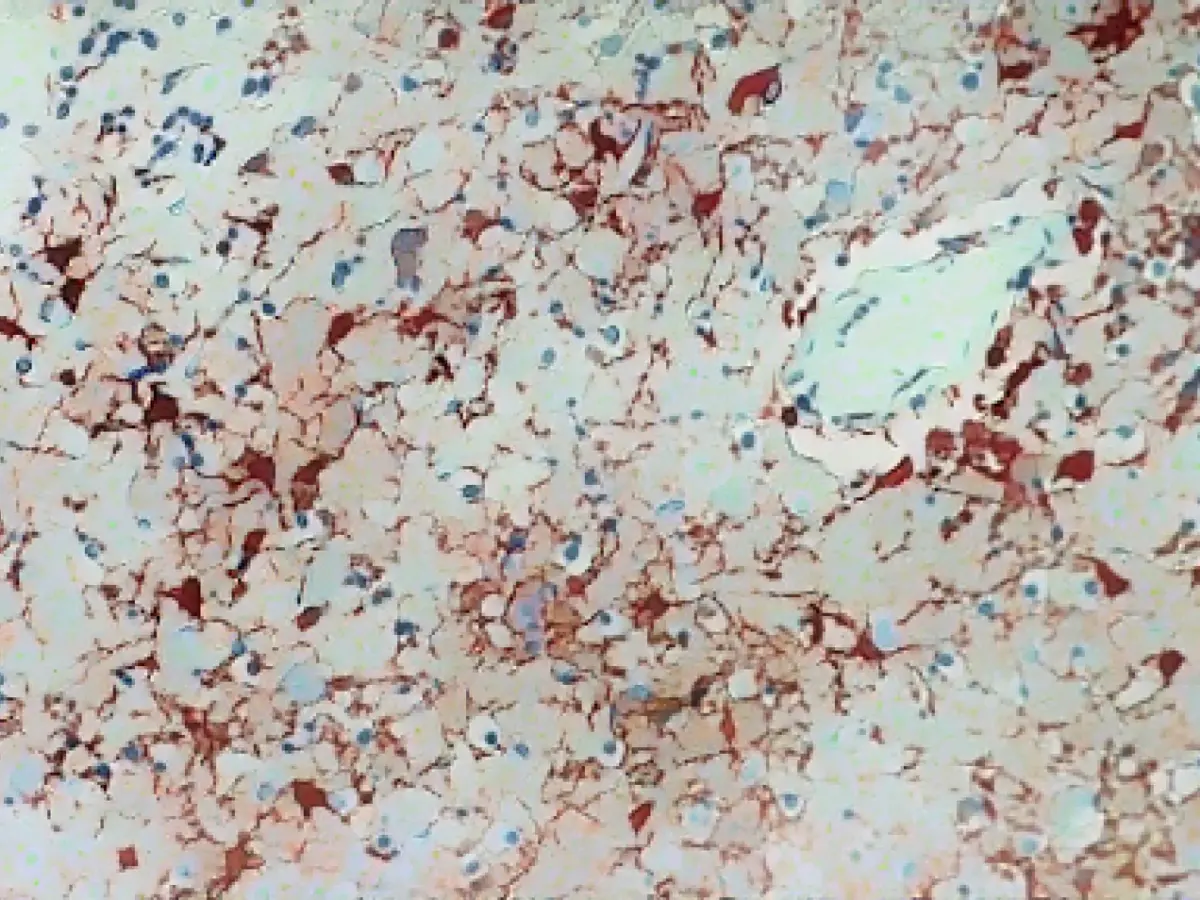 Man died after infection with Borna virus