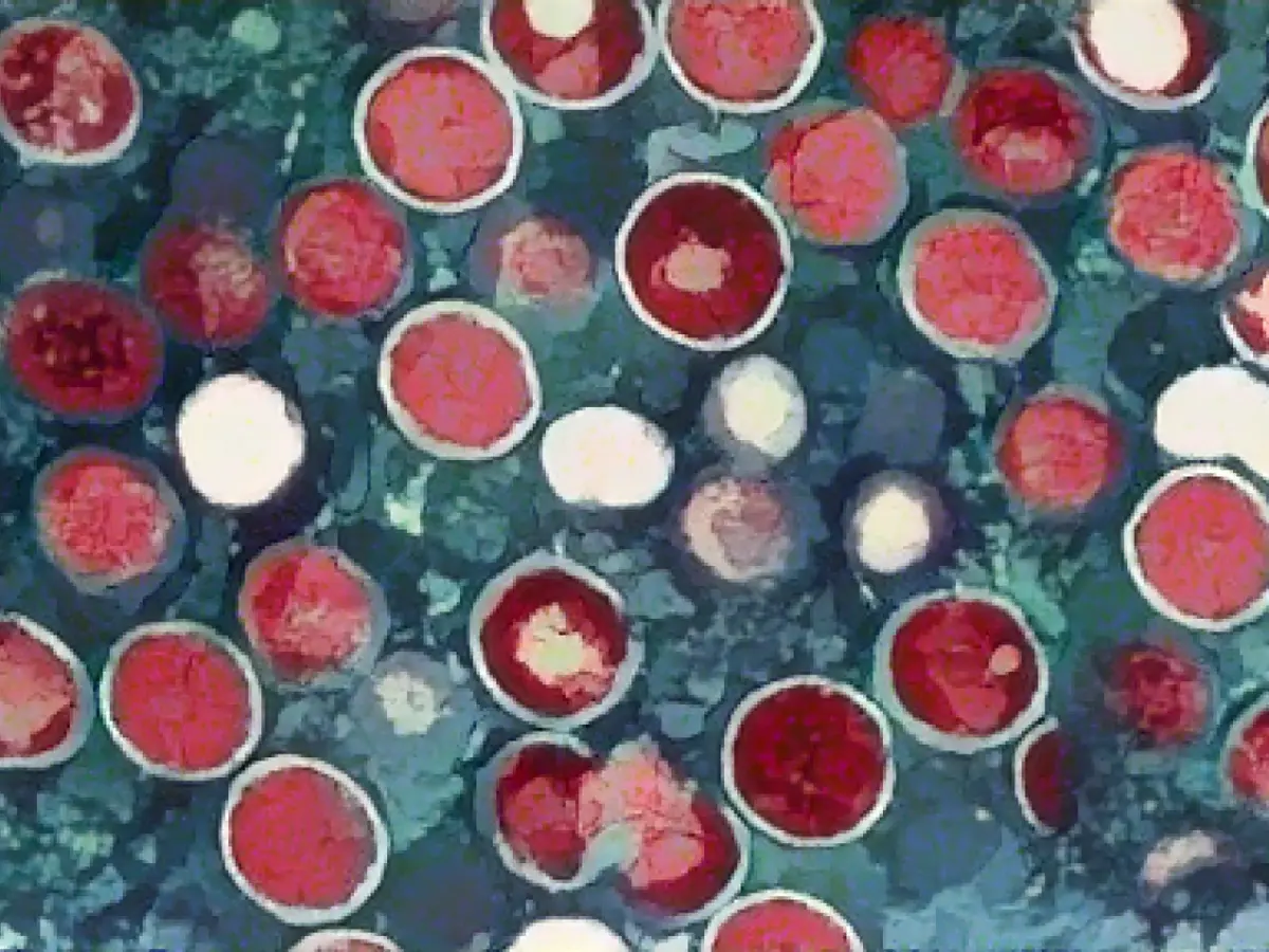 WHO sees global risk: 13,000 Mpox cases in Congo