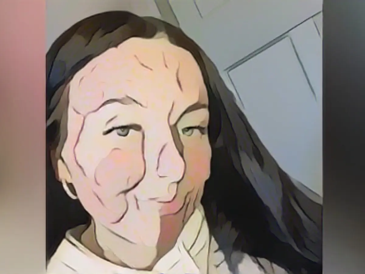 She was bullied at school, now she's an influencer - Courtney Jones shows her life with acne