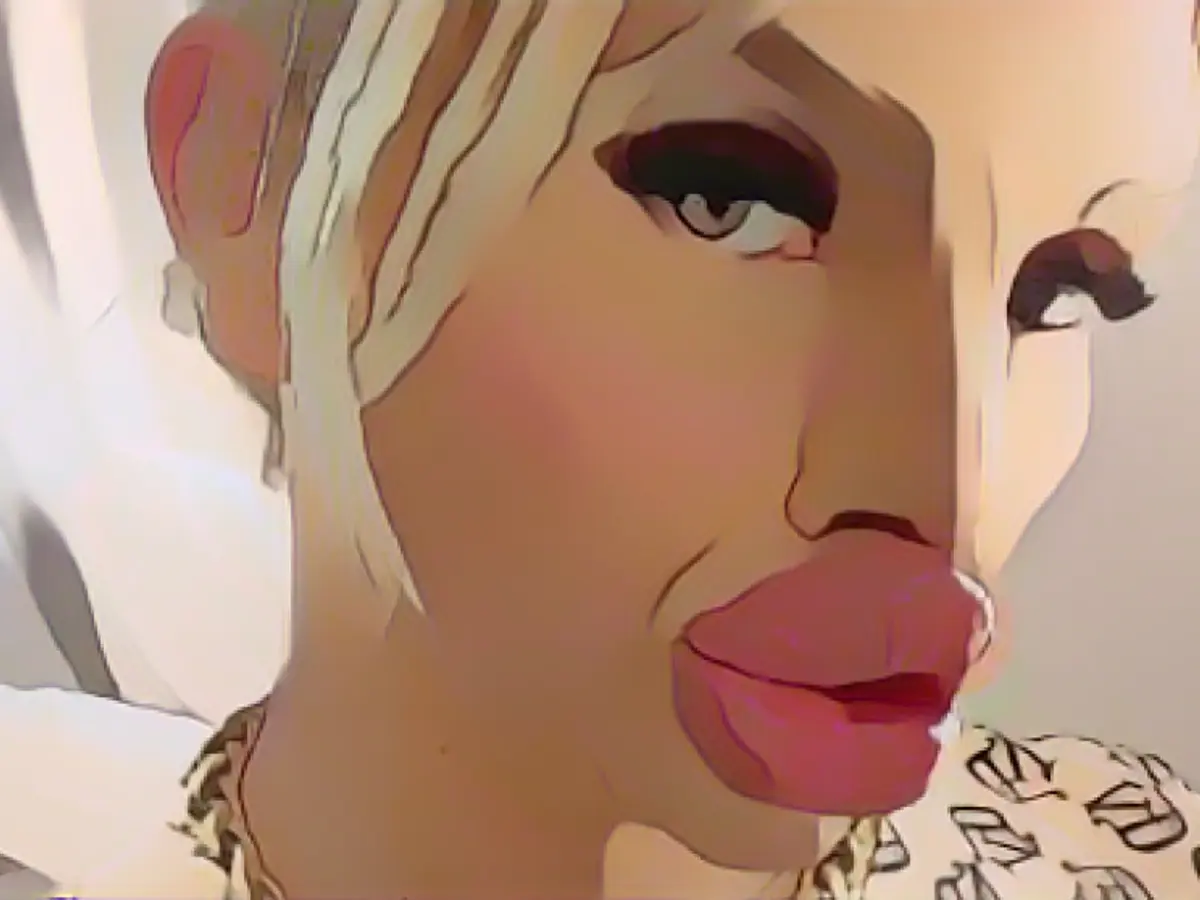 Influencer can barely eat because of giga lips