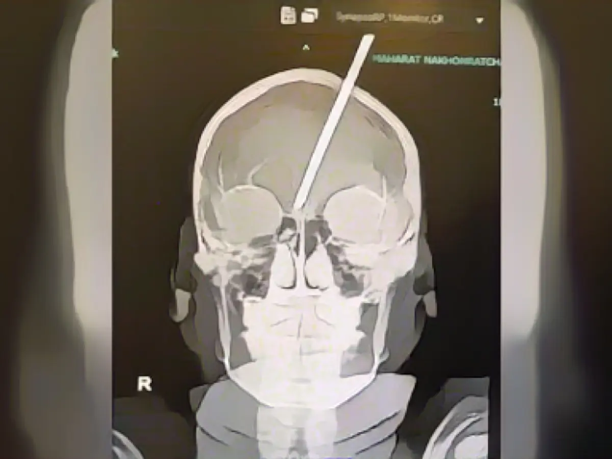 Boy shoots harpoon into his head