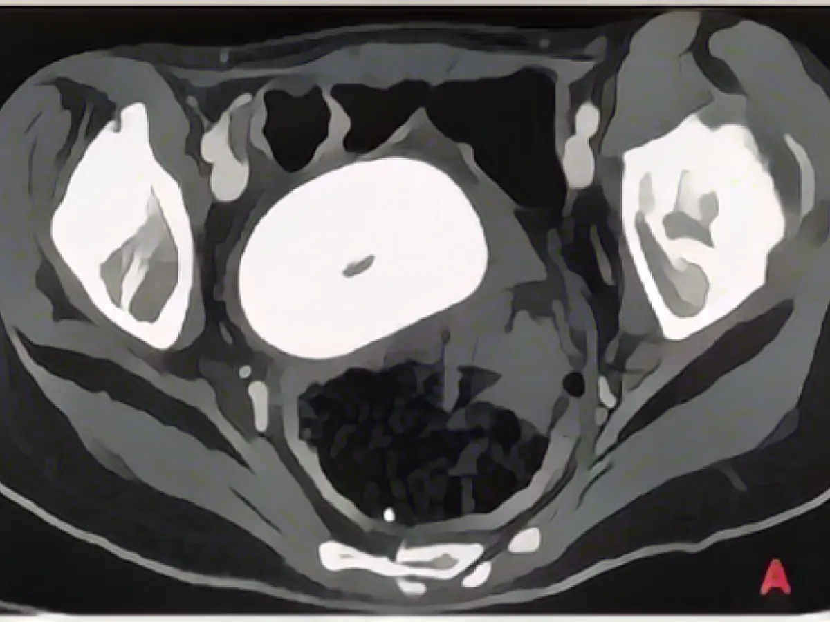 Doctors find XXL foreign body in vagina