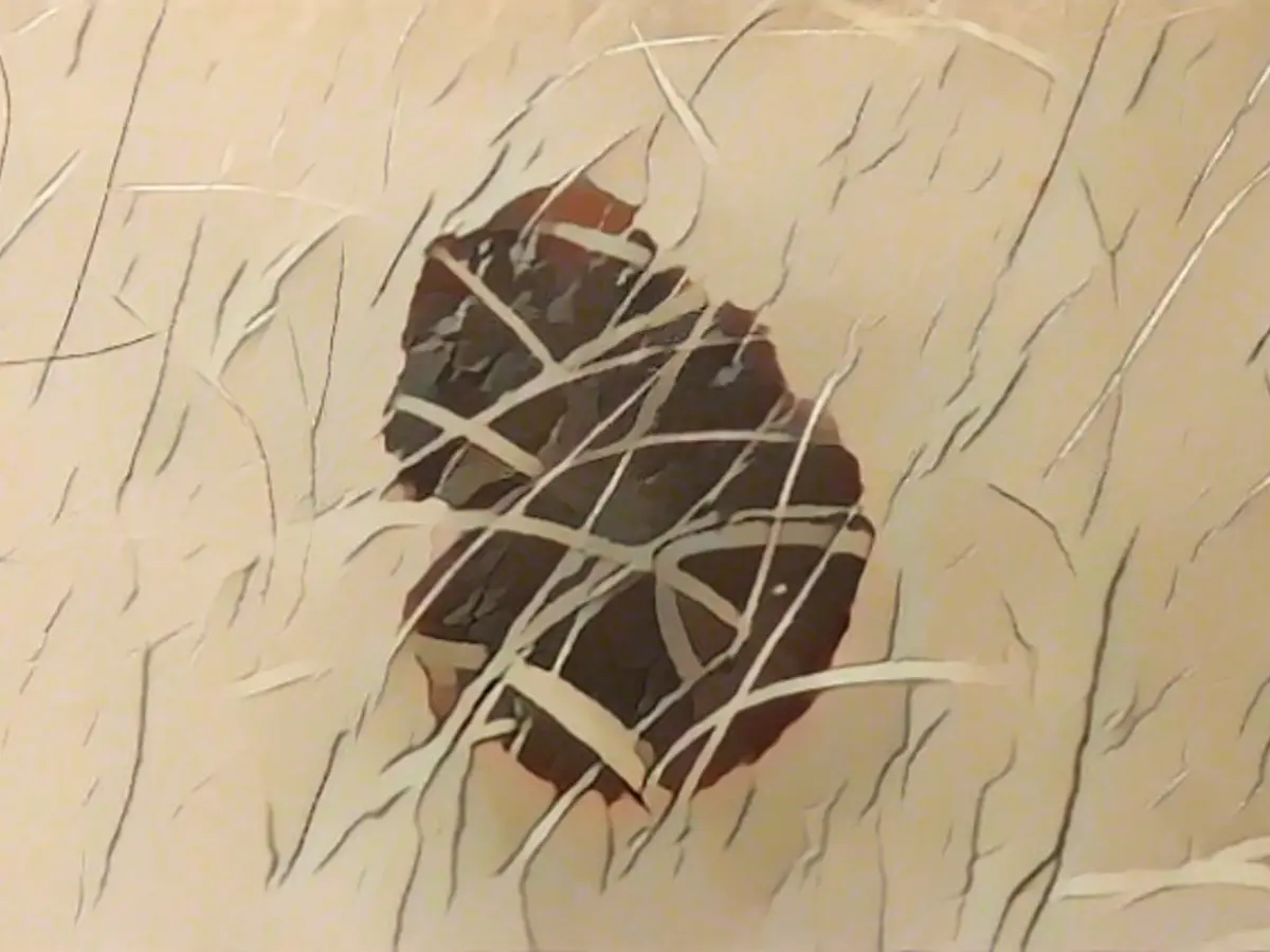 Moderna tests vaccine against black skin cancer