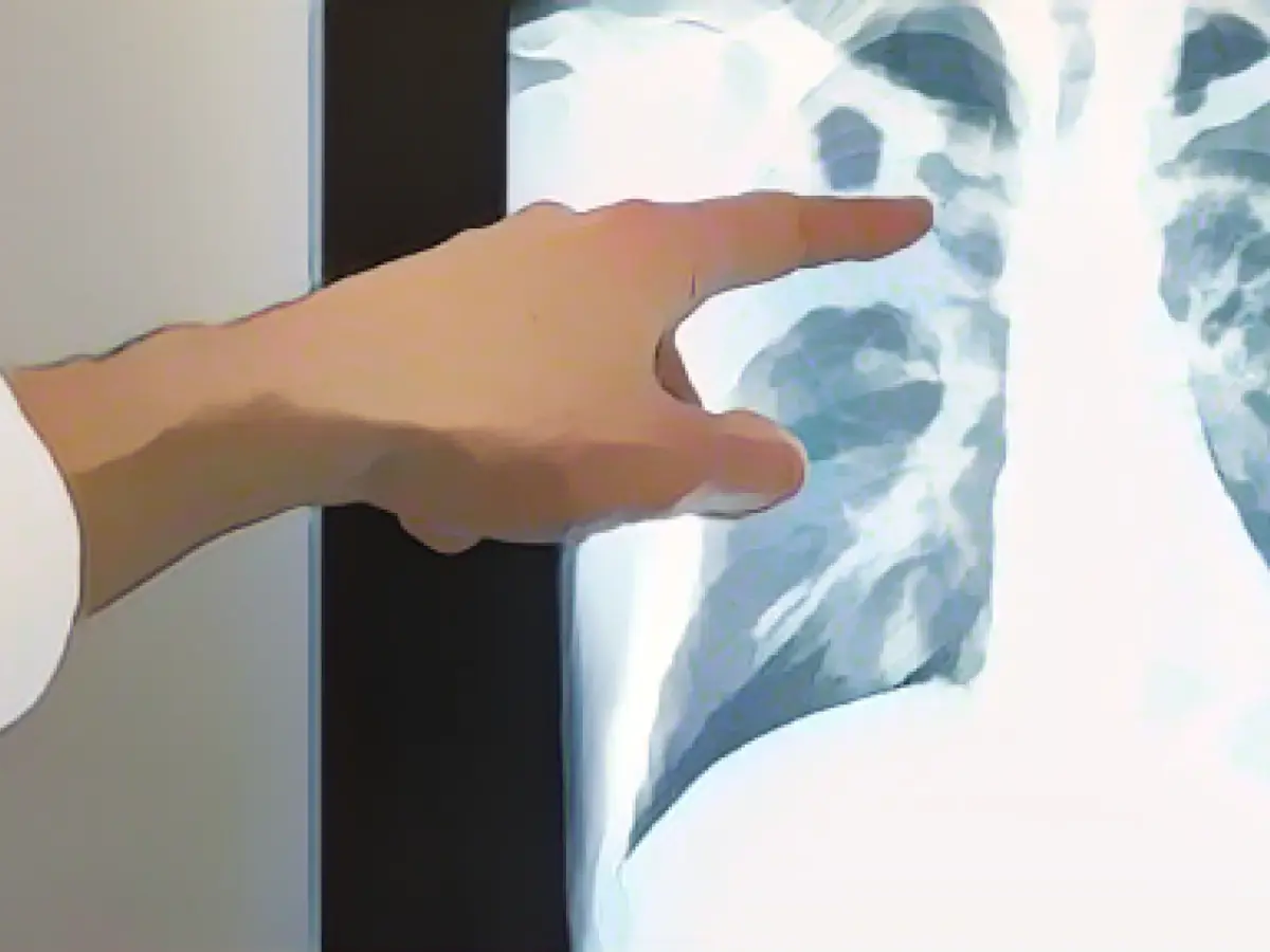 Number of tuberculosis cases in the southwest increases significantly